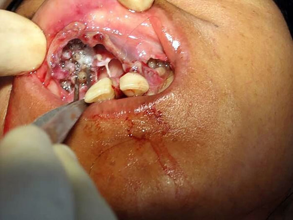 How to Treat Mouth Maggots