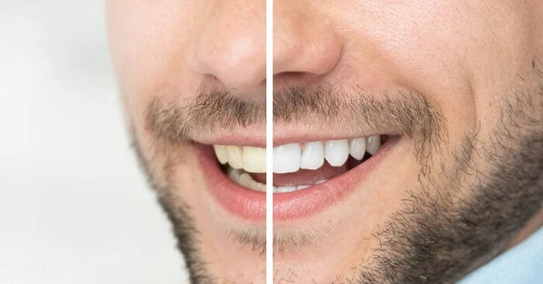 Lifestyle Adjustments for Preventing Stained Teeth