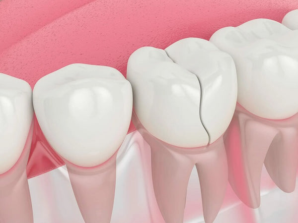 Major Complications due to Tooth Fracture