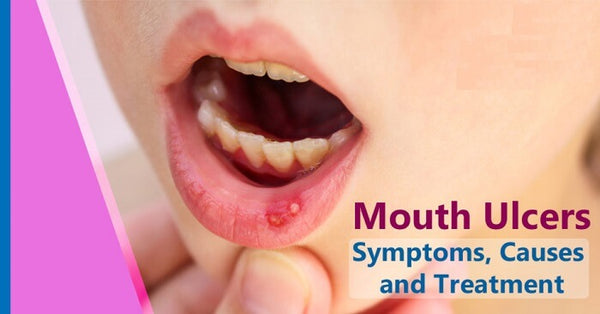 Symptoms of Mouth Ulcers