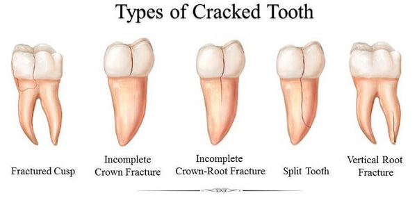 Types of Cracked Teeth