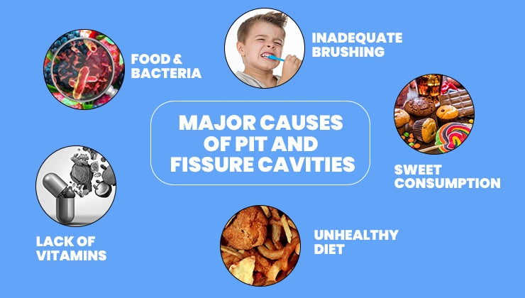 Causes of Pit and Fissure Cavities