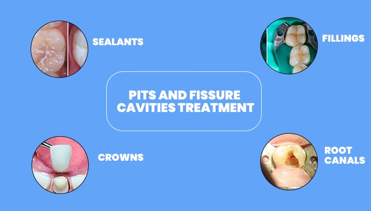 Pits and Fissure Cavities Treatment