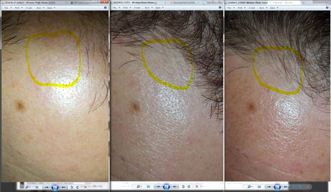 microneedling hair growth