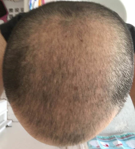 microneedling hair growth