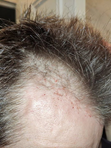 microneedling hair growth