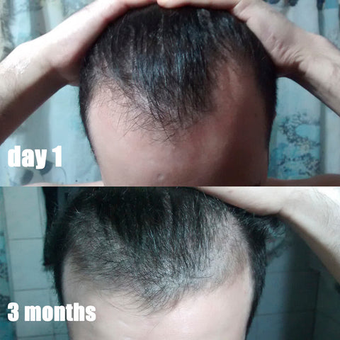 microneedling hair growth