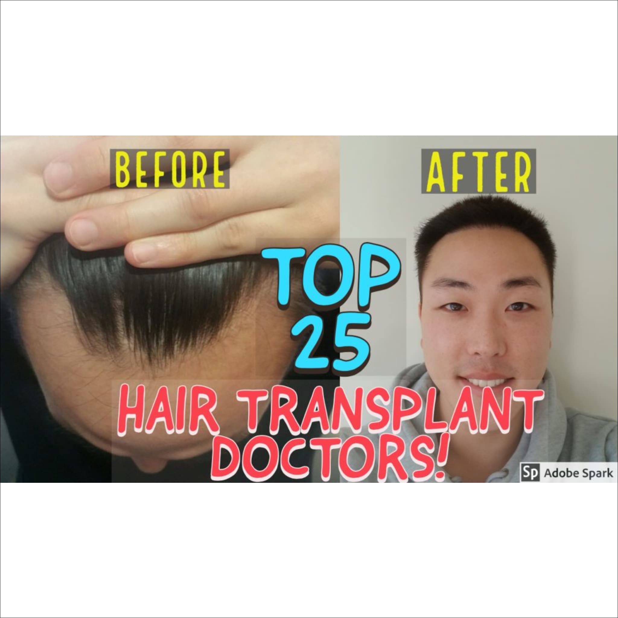 5 Best Hair Transplant Doctors in India