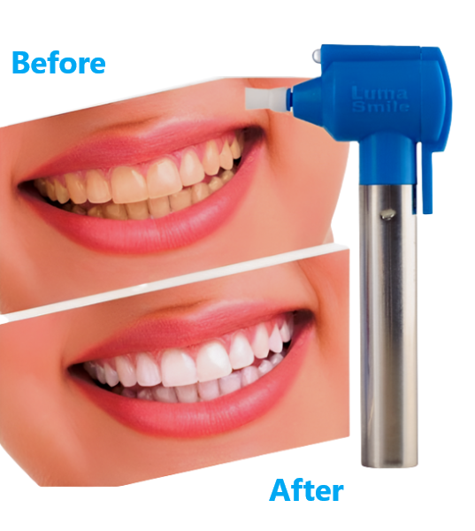 Luma Smile Teeth Whitening and Polishing Device 0