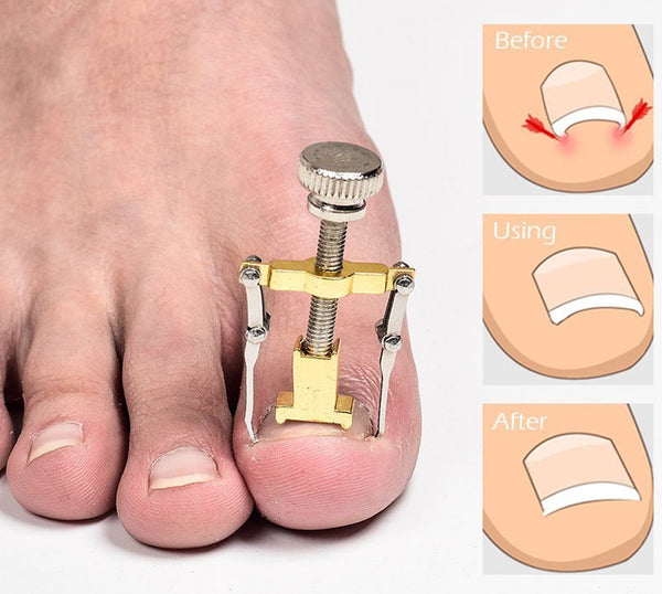 Ingrown Toenail Corrector Clamp 1