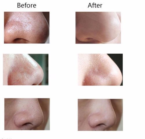 Pore Cleansing Blackhead, Pimple, Zit & Acne Remover 4