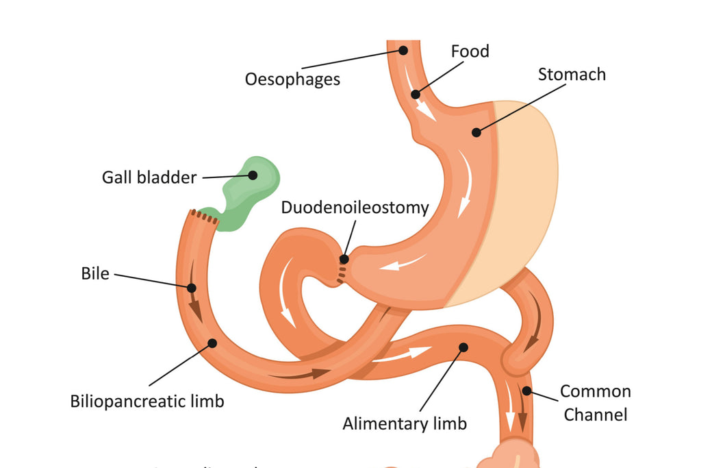 duodenal switch surgery