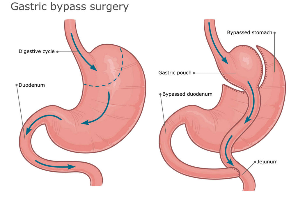 gastric bypass surgery