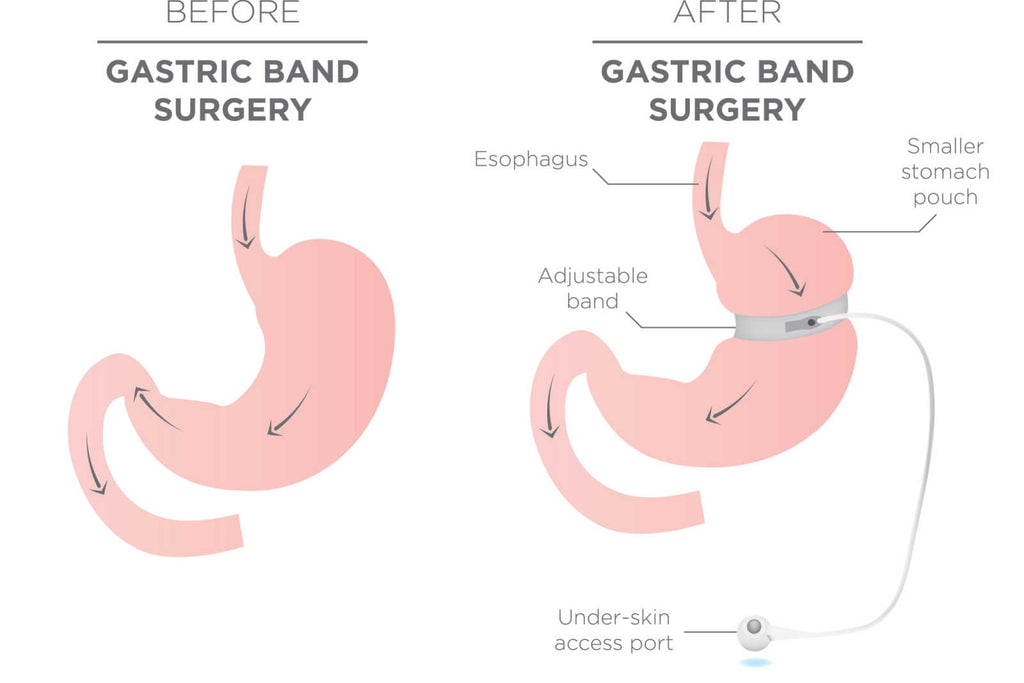 adjustable gastric band