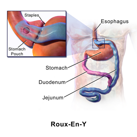 Bariatric Surgeries to Treat Sleep Apnea