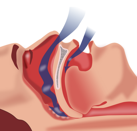 sleep apnea and bariatrics