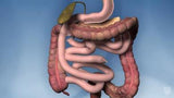 Biliopancreatic Diversion With Duodenal Switch