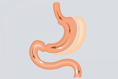 gastric sleeve