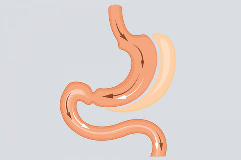 sleeve gastrectomy