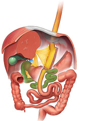 Mini Gastric Bypass Surgery