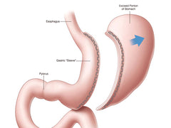 gastric bypass
