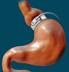 Adjustable Gastric Band