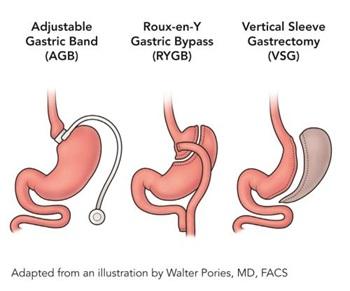 Gastric Surgery and Acid Reflux – Bariatric Fusion