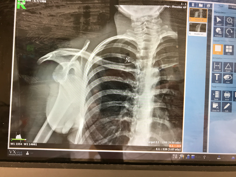 Jo's X-ray of her shoulder injury.