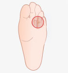 Drawn image diagram of swollen nerve, Morton's Neuroma, between third and fourth toe on bottom side of the foot