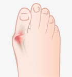 Bunions Causes