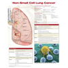Non Small Cell Lung Cancer Anatomical Chart