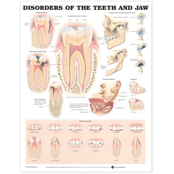 Disorders of the Teeth and Jaw Anatomical Chart