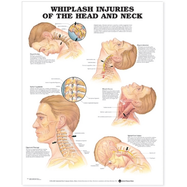 Whiplash Injuries of the Head and Neck Anatomical Chart