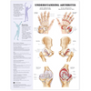 Understanding Arthritis Anatomical Chart