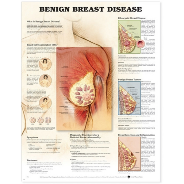 Benign Breast Disease Anatomical Chart