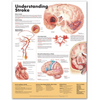 Understanding Stroke Anatomical Chart