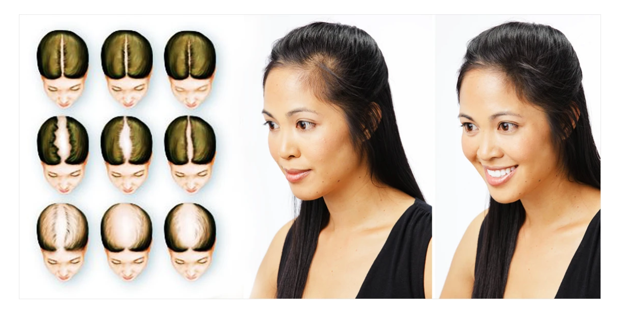 PRP for hair loss Can it reverse baldness without surgery pills or  creams  Plastic Surgery  UT Southwestern Medical Center