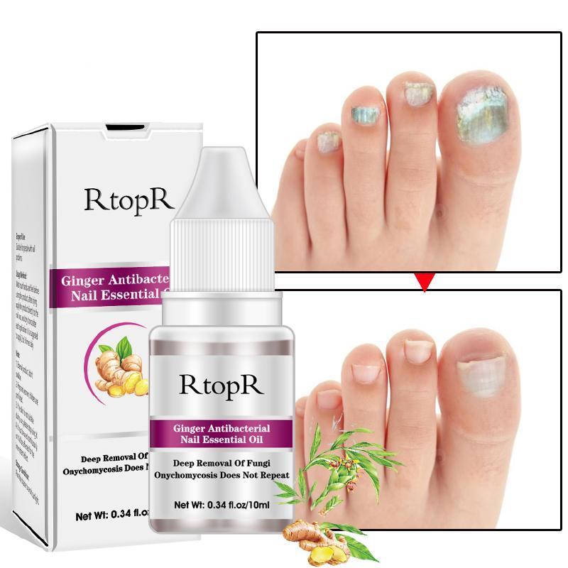 Thumbnail Infection Treatment ginger anti fungal nail infection treatment essential oil my lifestyle stores