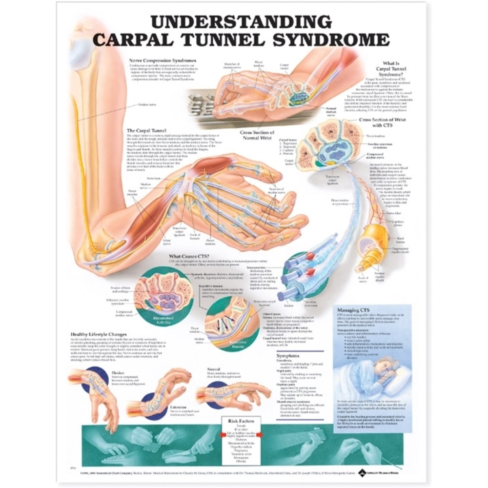 Understanding Carpal Tunnel Syndrome Anatomical Chart Medshop Singapore