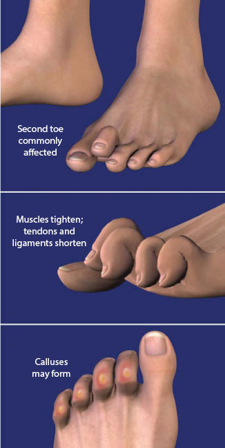 How to Wiggle Your Small Toe Separately from the Rest of Your Toes