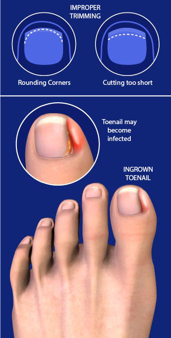 Fix Your Feet | Ingrown Toenails