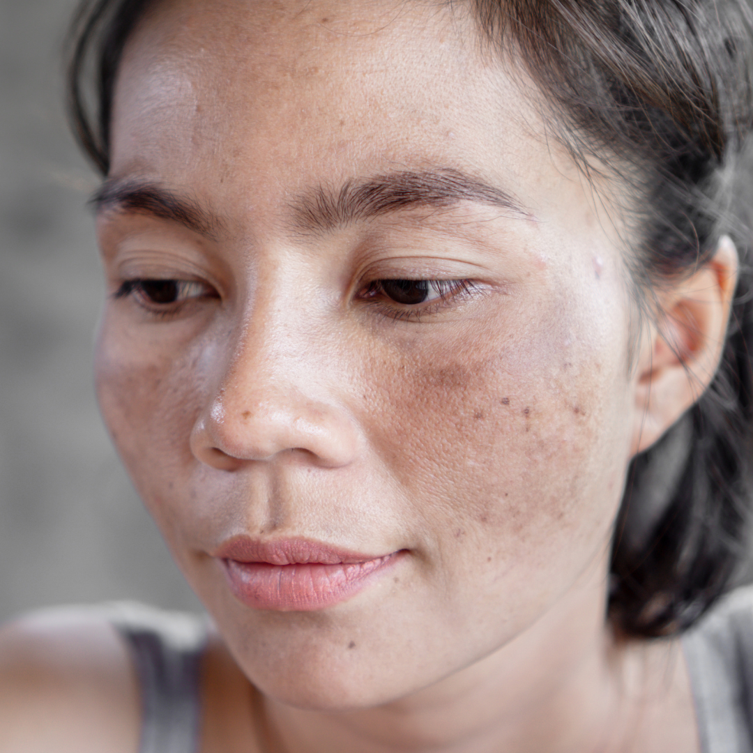 melasma