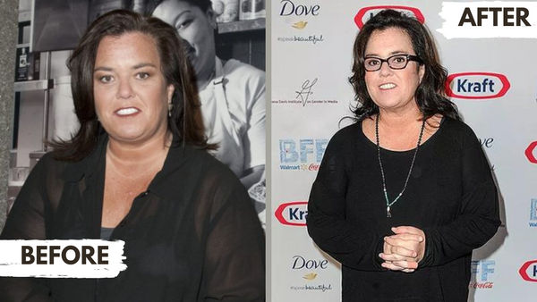 Rosie O'donnel Before and After Bariatric Surgery