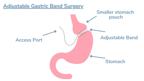 gastric banding surgery graphic