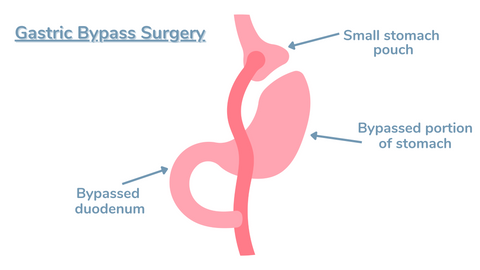 gastric bypass surgery graphic
