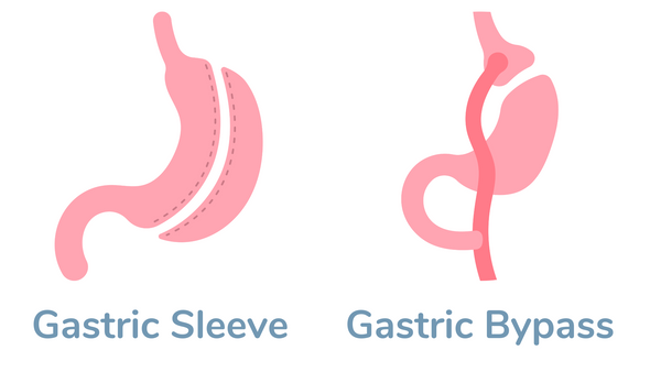 gastric bypass vs gastric sleeve surgery