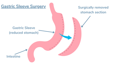 gastric sleeve surgery graphic
