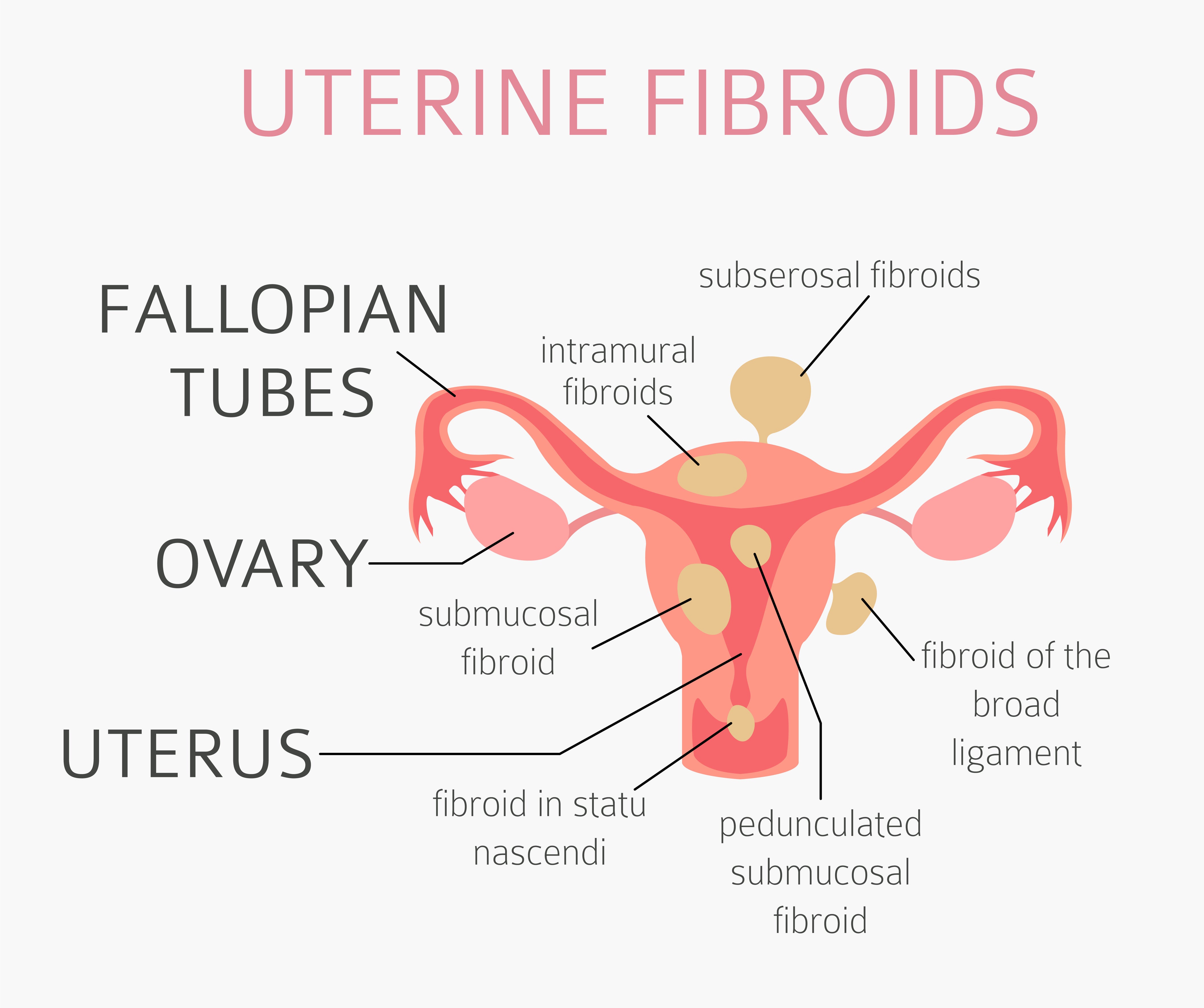 Diagram of Uterine Fibroids 