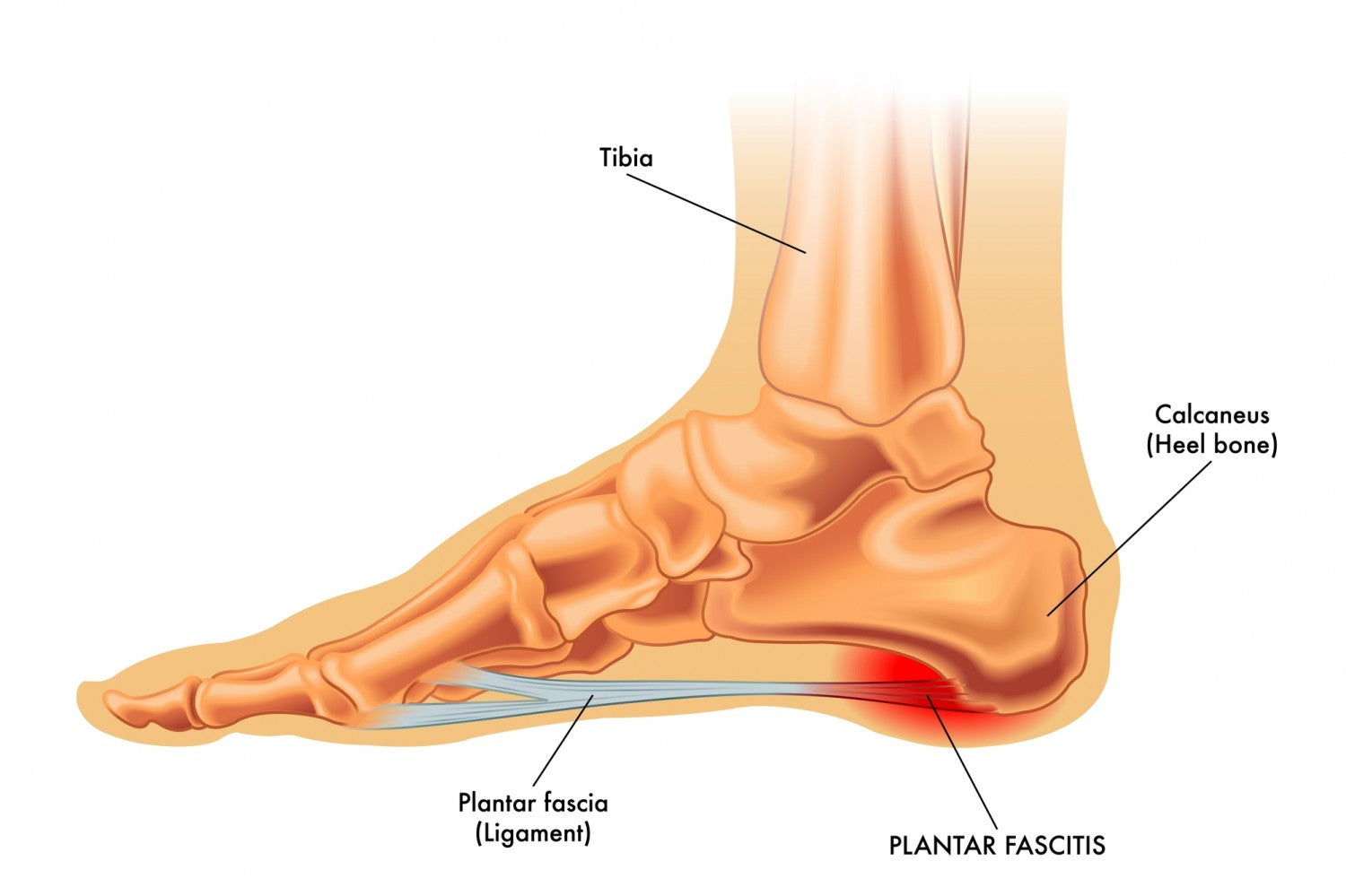 Treatments for Flat Feet | The Podiatry Group of South Texas