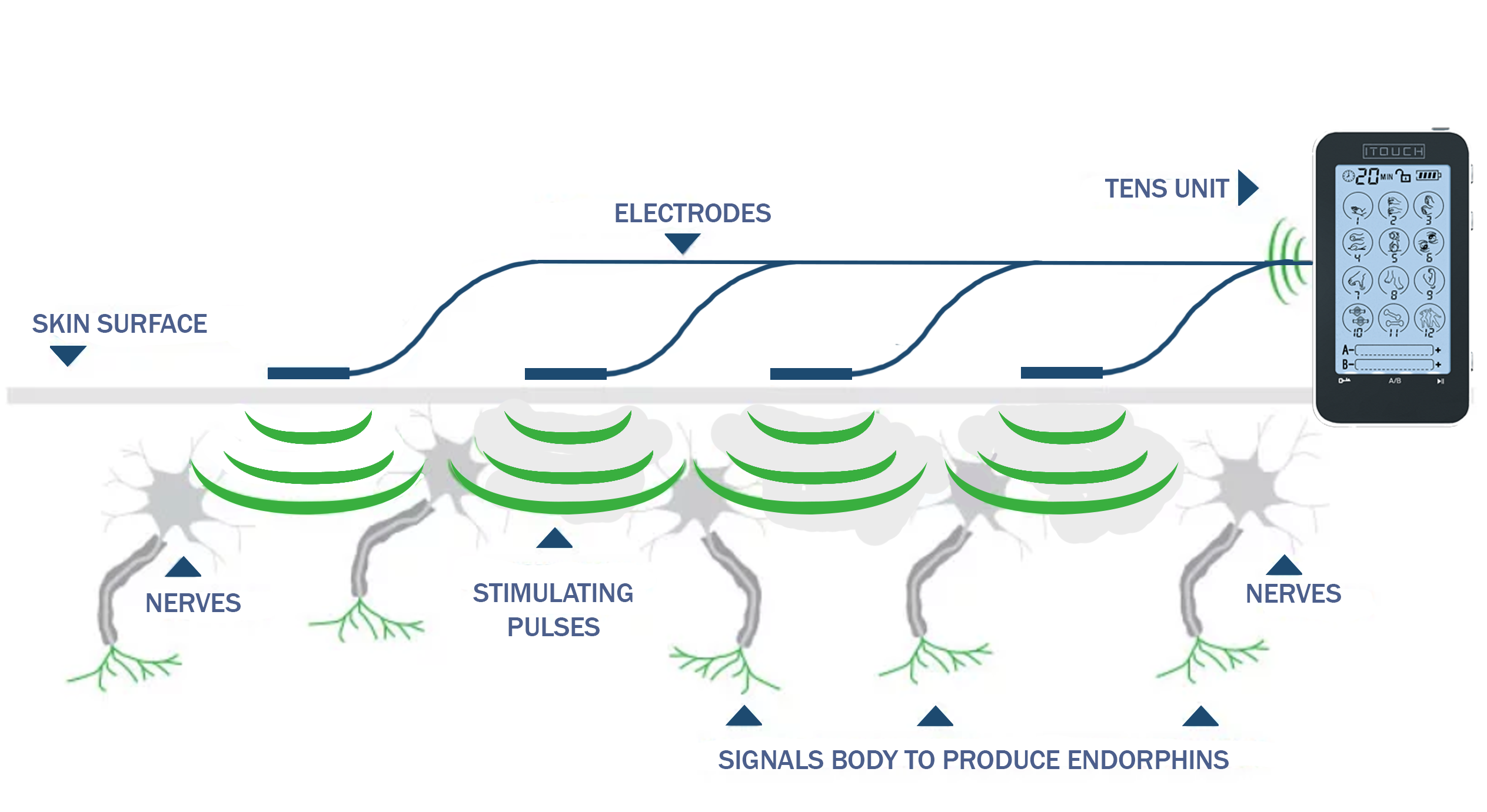 How Does A TENS Unit Work And Could It Help Me?